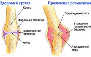 Причины, симптомы и лечение ревматизма