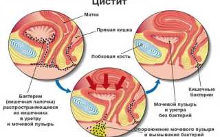 Причины, симптомы и лечение цистита