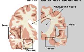 Причины, симптомы и лечение болезни Альцгеймера