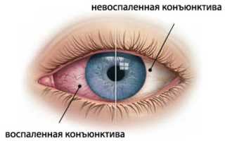 Симптомы, лечение конъюнктивита у детей и взрослых