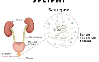 Кишечная палочка возбудитель уретрита