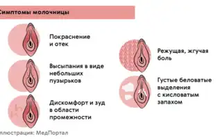 Может ли быть молочница из за смены климата