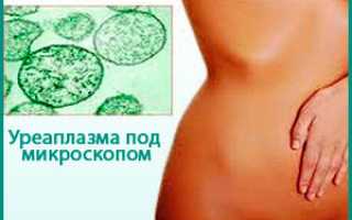 Уреаплазма цистит молочница