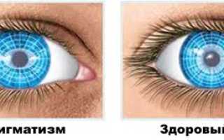 Причины, симптомы и лечение астигматизма