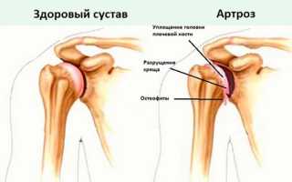 Причины, симптомы и лечение артроза