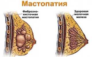 Симптомы и лечение мастопатии молочной железы