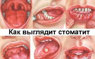 Причины, симптомы и лечение стоматита