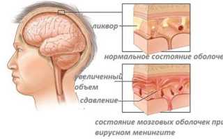 Причины, симптомы и лечение менингита