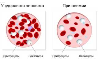Причины, симптомы и лечение анемии