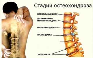 Просыпание с болью в пояснице