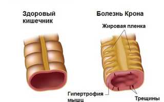 Симптомы, диагностика и лечение болезни Крона