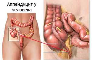 Причины, симптомы и лечение аппендицита
