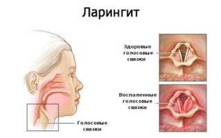 Симптомы и лечение ларингита у взрослых и детей