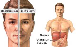 Симптомы и лечение болезни Жильбера