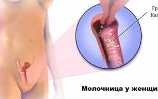 Причины, симптомы и лечение молочницы