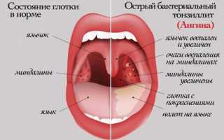 Причины, симптомы и лечение ангины