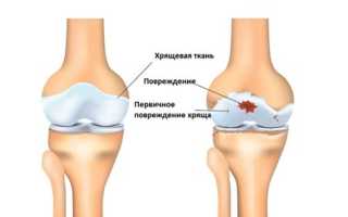 Симптомы и лечение остеоартроза