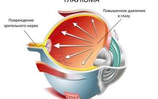 Причины, симптомы и лечение глаукомы