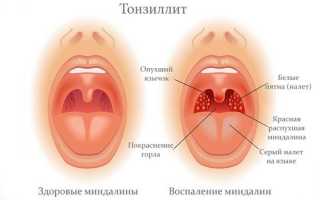 Причины, симптомы и лечение тонзиллита