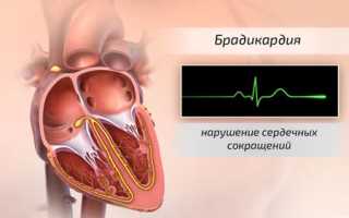 Причины, симптомы и лечение брадикардии