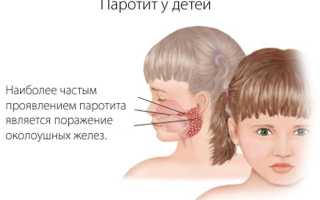 Причины, симптомы и лечение паротита (свинки)