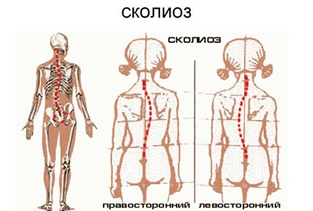 Сколиоз