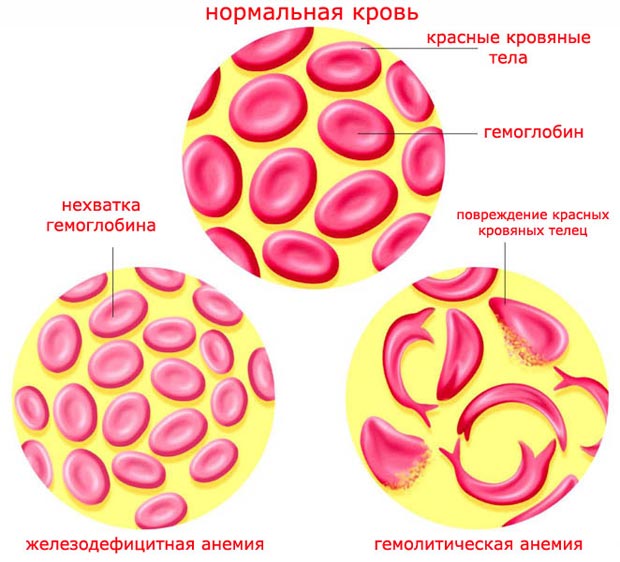 Гемолитическая анемия