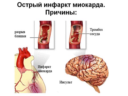 Причины инфаркта миокарда