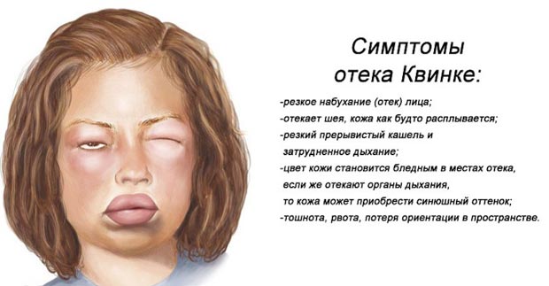 Симптомы отека Квинке