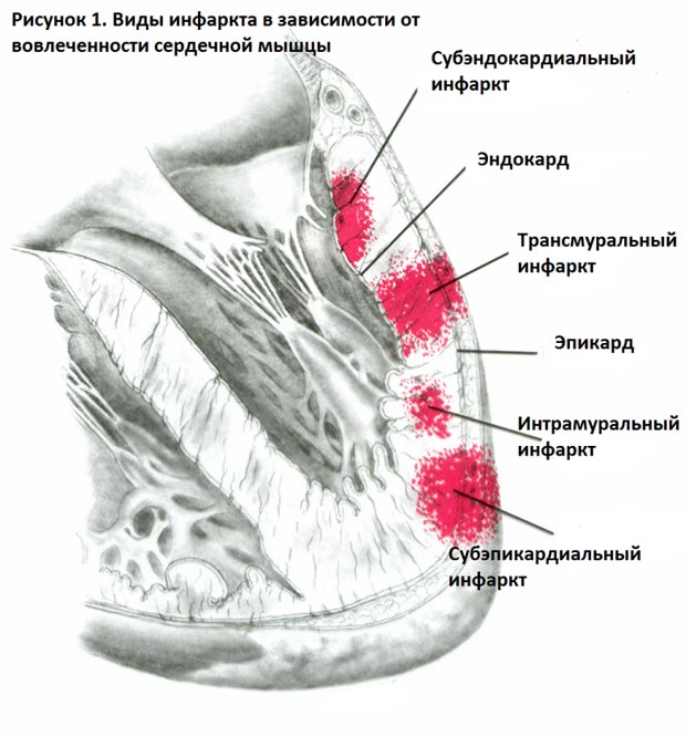Виды инфаркта