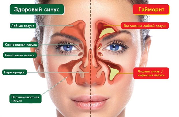 Гайморит и здоровый синус