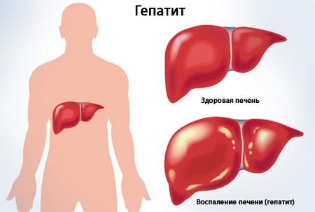 Воспаление печени (гепатит)