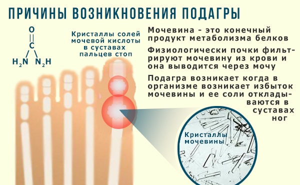 Причины развития подагры