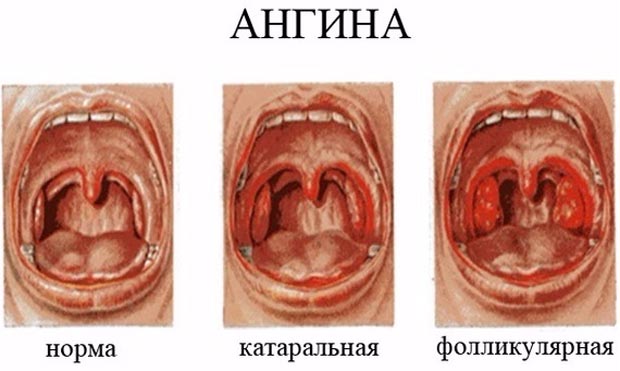 Катаральная ангина