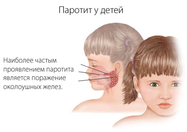 Эпидемический паротит
