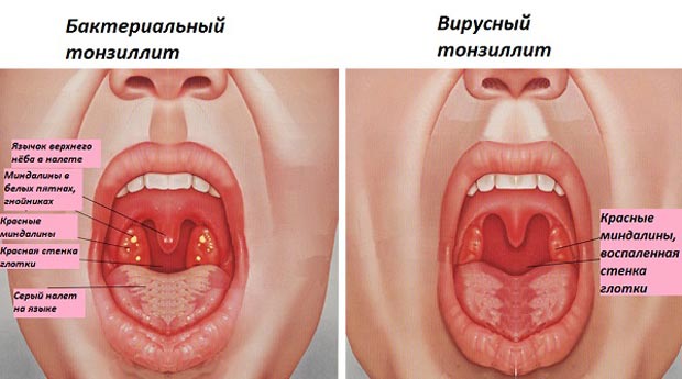 Бактериальный и вирусный тонзиллиты