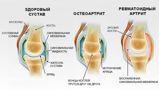 Примеры ревматических заболеваний