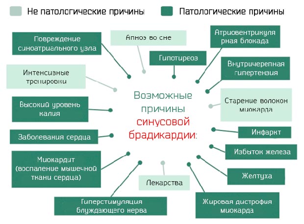 Причины синусовой брадикардии 