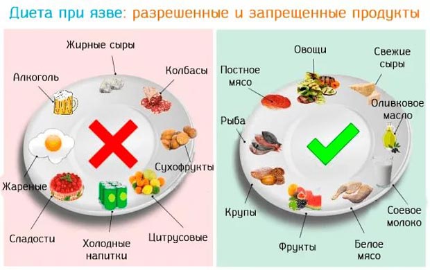 Диета при язве желудка