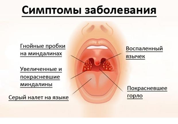 Симптомы ангины