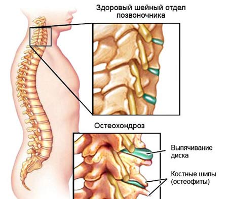 Остеохондроз