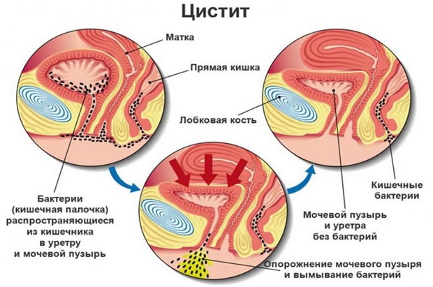 Цистит 