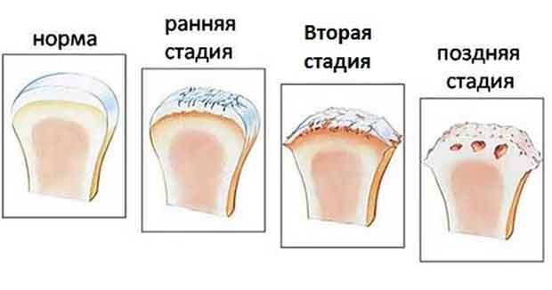 4 стадии артрита 
