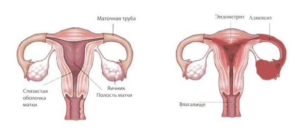 Хронический эндометрит