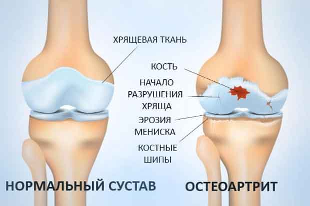 Остеоартрит 