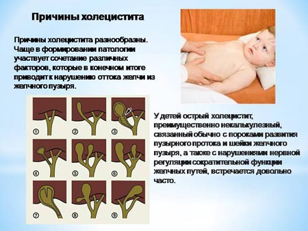 Причины холецистита 