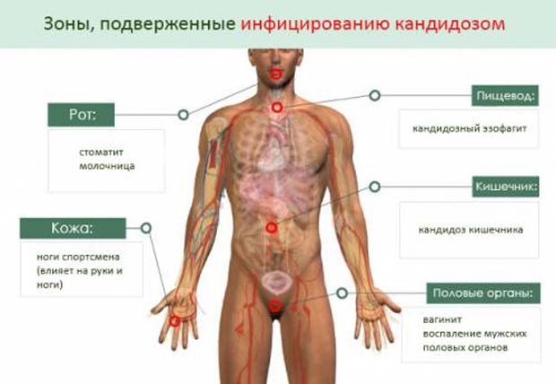 Зоны, подверженные инфицированию кандидозом