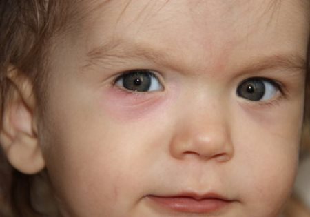 Ячмень на глазу у ребенка