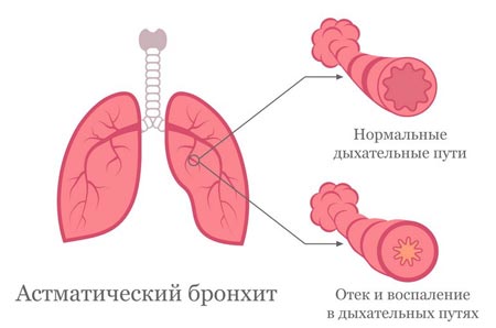 Хронический астматический бронхит