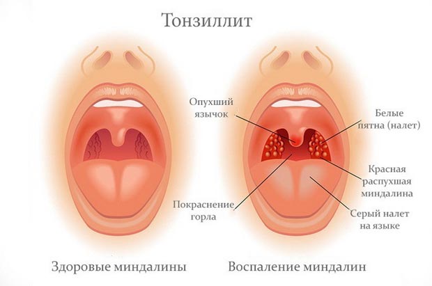 Тонзиллит